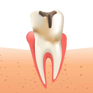 How to prevent tooth decay in Falls Church, VA at Pike Smiles