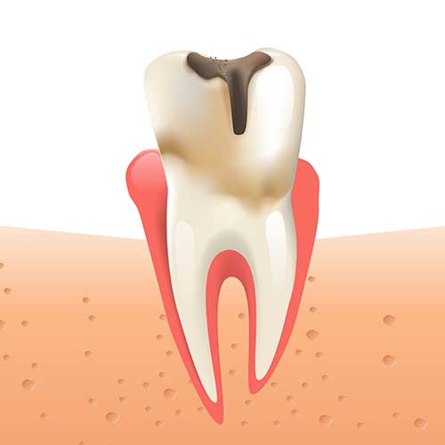 illustration of tooth with decay