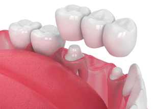 Dental Crowns and Bridges in Falls Church, VA at Pike Smiles