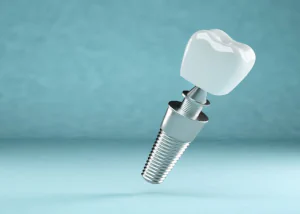 Pros and cons of Dental Implants in Falls Church, VA at Pike Smiles
