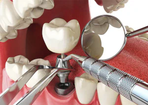 Dental Implant Safety in Falls Church, VA at Pike Smiles