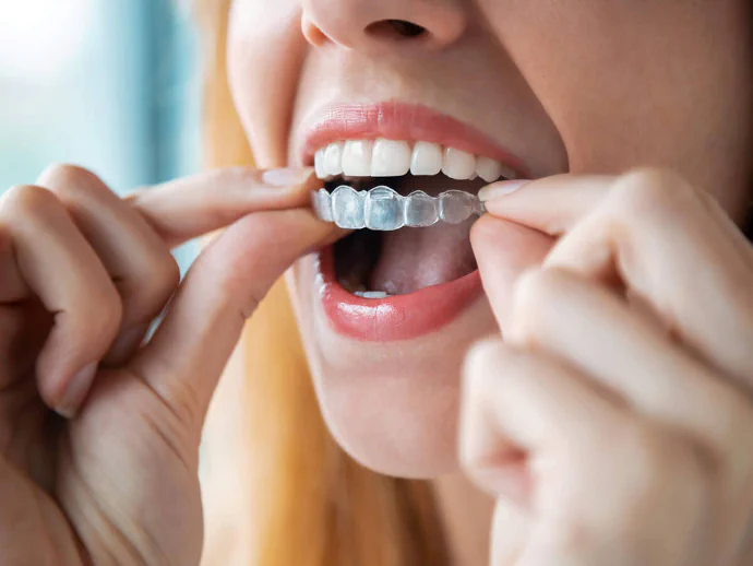 Invisalign Clear Aligners in Falls Church, VA at Pike Smiles